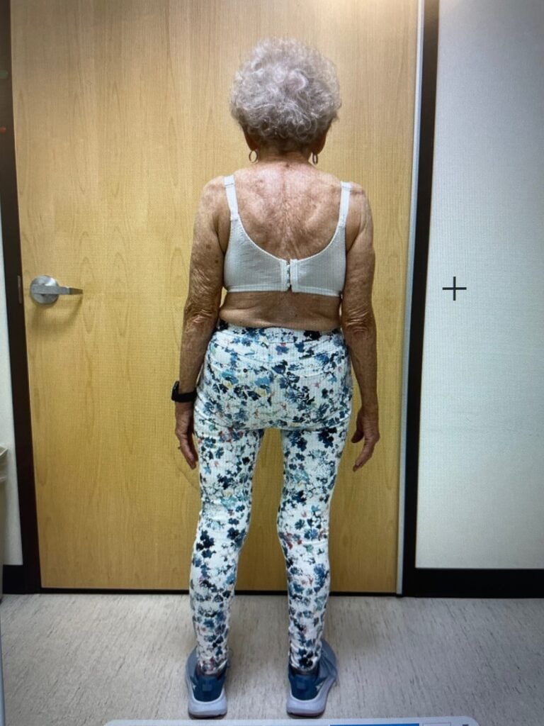 after scoliosis treatment photo