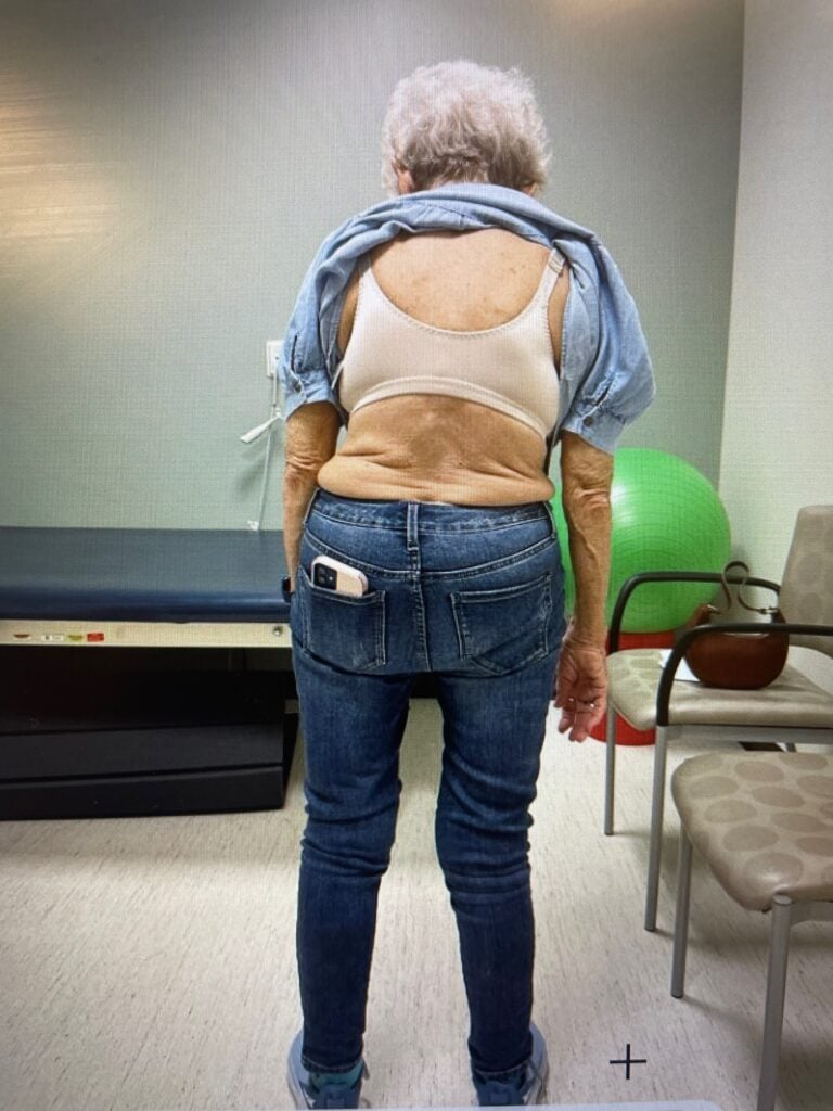 Before scoliosis treatment photos