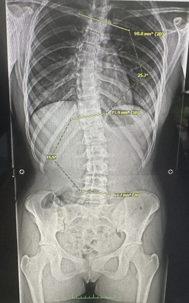 scoliosis x-ray